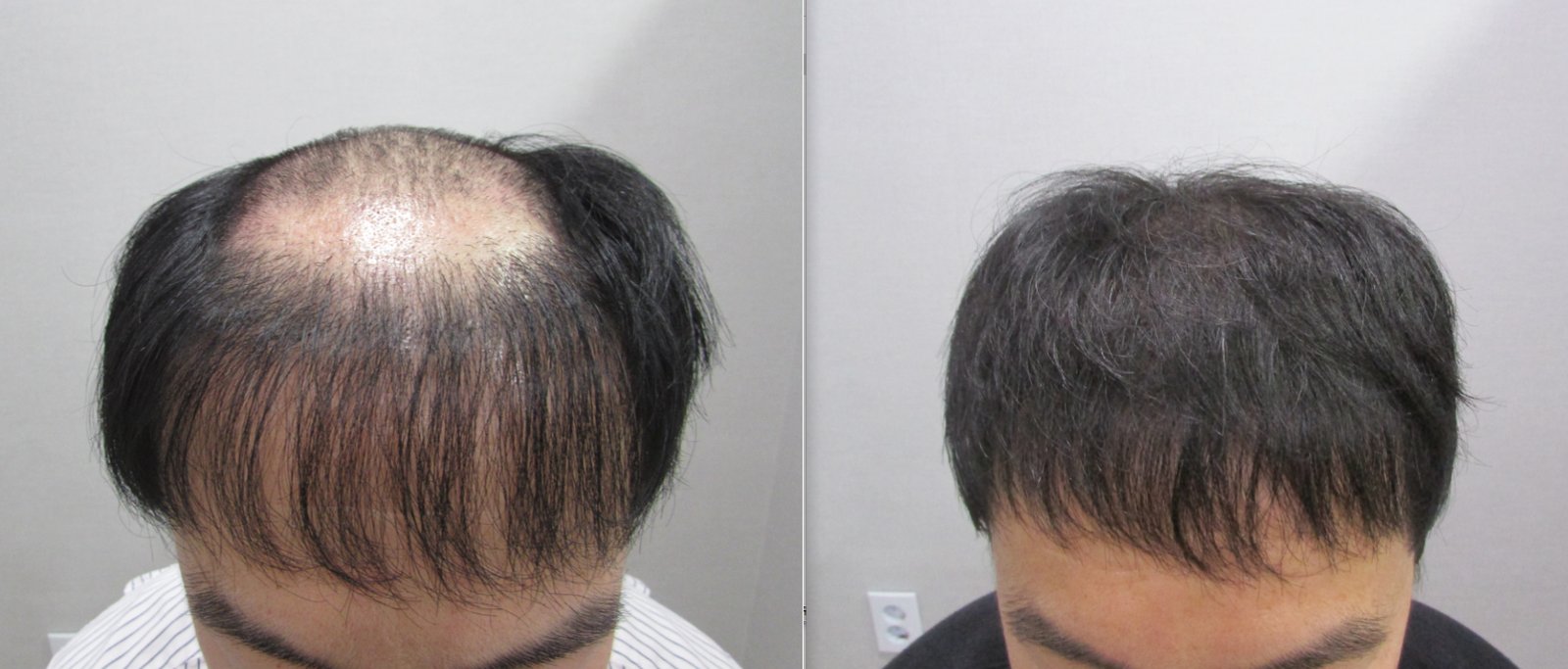 頭頂部 植毛+SMPの症例写真(40代前半 男性・1年経過)|ヨンセモベル医院 鍾路本店