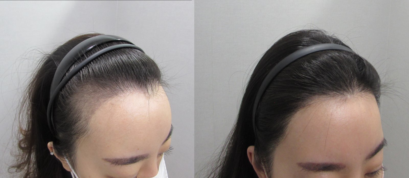 ヘアライン矯正の症例写真(30代後半 女性・9ヶ月経過)|ヨンセモベル医院 鍾路本店