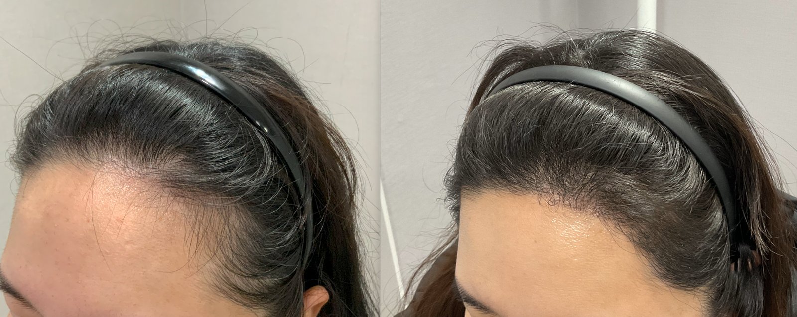 ヘアライン矯正の症例写真(30代半ば 女性・6ヶ月経過)|ヨンセモベル医院 鍾路本店