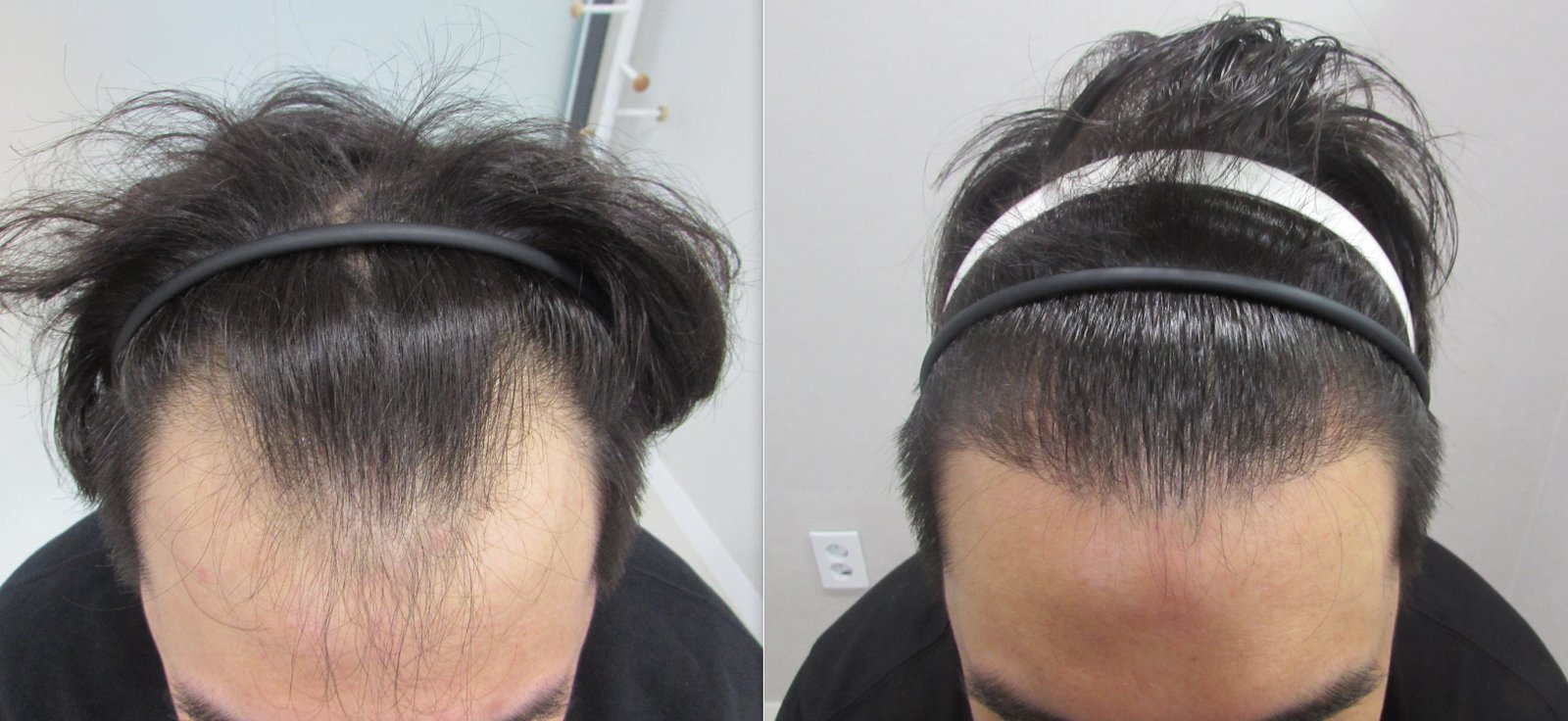 M字 自毛植毛の症例写真(30代前半 男性・1年7ヶ月経過)|ヨンセモベル医院 鍾路本店